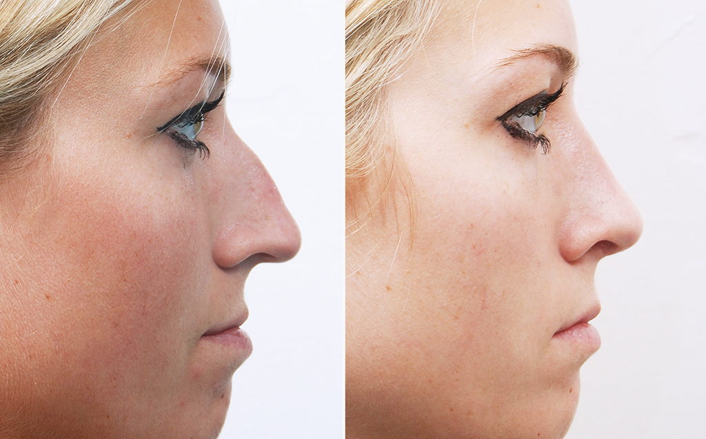 Ты можешь не верить, но это реально: как изменить форму носа без операции?  - STYLE Гид-Инфо